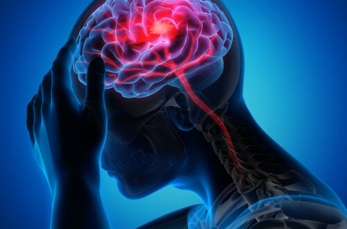 stroke symptoms